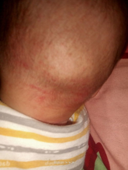 Kepala bayi bintik merah