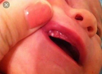 Gusi baby 4m saya keluar bintik ni