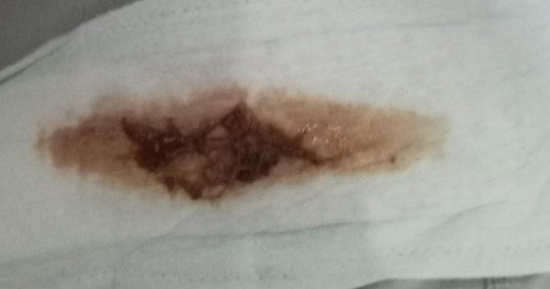 Usia kehamilan 9weeks selalu keluar flek kecoklatan