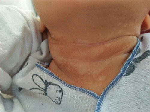 Kulit Newborn bercak putih