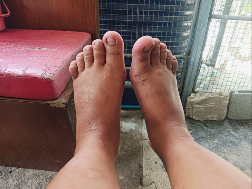 37+2วีค เท้าบวมมือบวมมากๆ