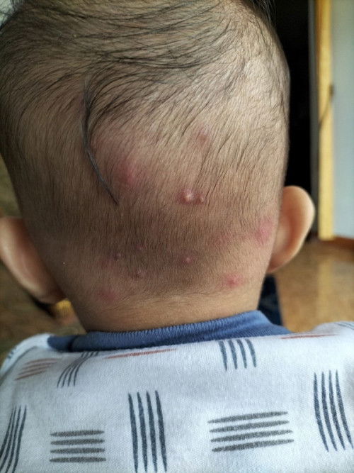 Benjolan kecil banyak, bernanah juga