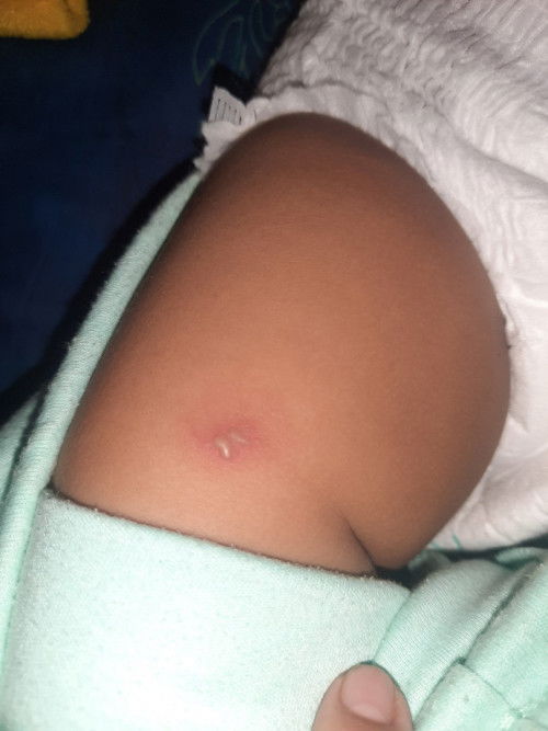 Melepuh seperti herpes