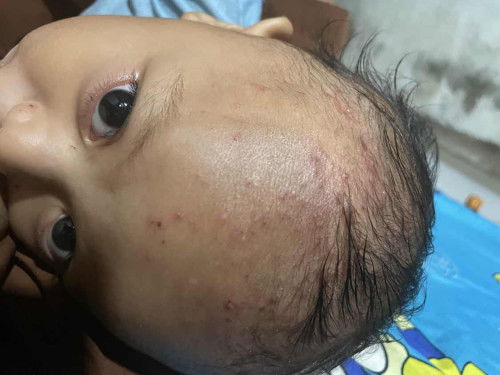 Bintik bintik bernanah di kepala anakku