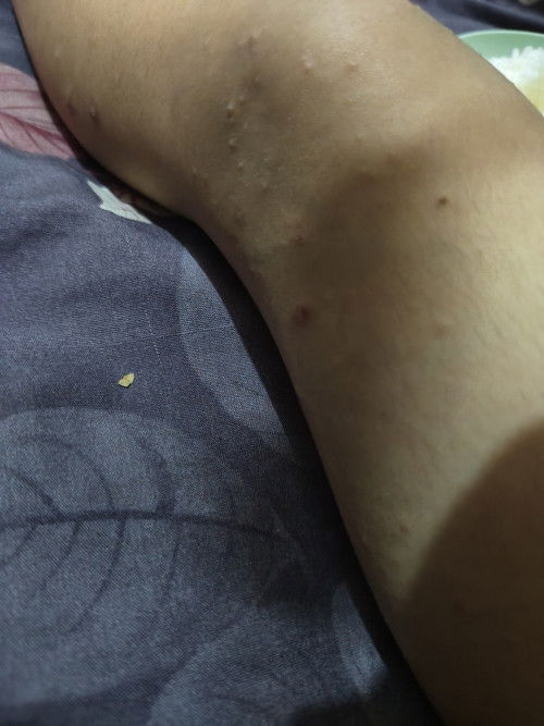 Gatal gatal di badan