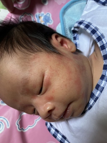 สอบถามแม่ๆ แบบนี้เป็นผื่นผดร้อน หรือว่า ผื่นแพ้อะไรไหมคะ