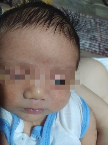 Allergy o baby acne