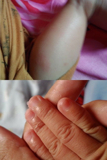 Kulit tangan mengelupas