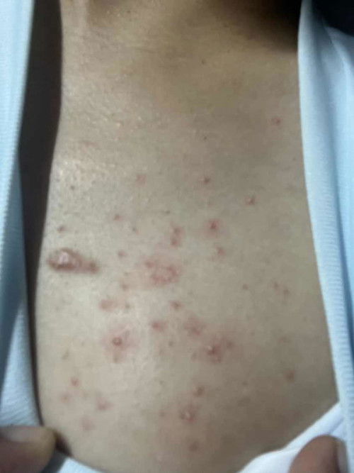 แม่ๆคนไหนมีอาการแพ้ เป็นผื่นขณะตั้งครรภ์มั้ยคะ