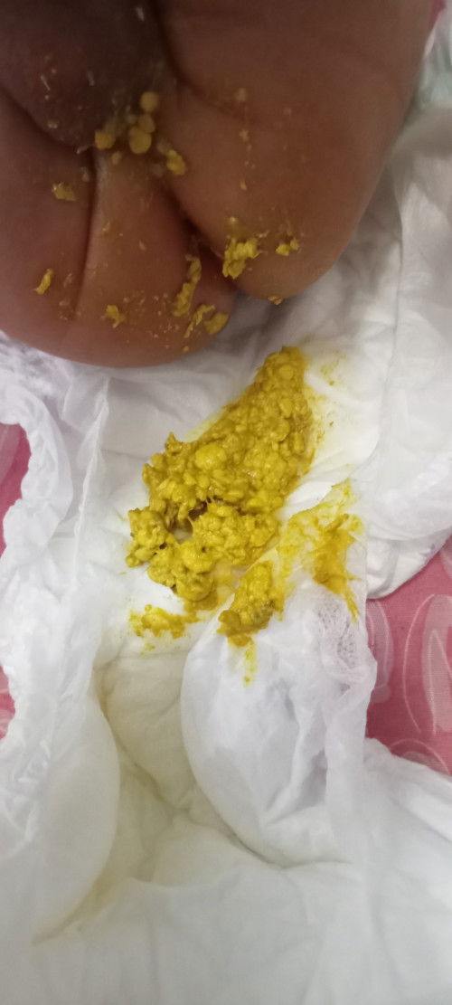 ถ่ายปกติไหมแบบนี้  น้องลองกินนมผง1วัน