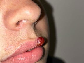 Pyogenic granuloma (PG) pregnancy tumor