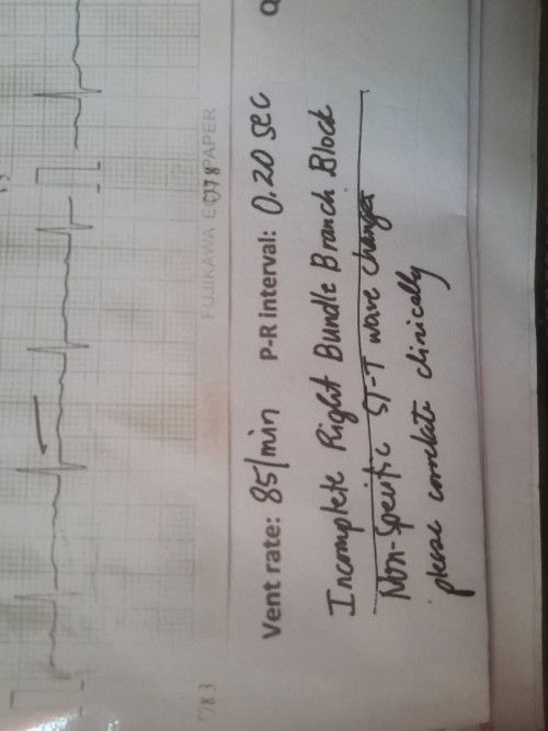 ECG Result - IRBBB. Is this something serious?