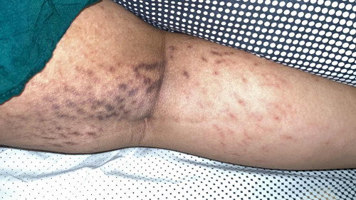 stretch mark