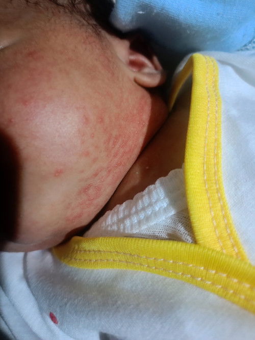 kemerahan,seleher2 dan di muka