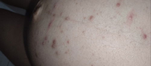 Jerawat perut, punggung,sekitar paha