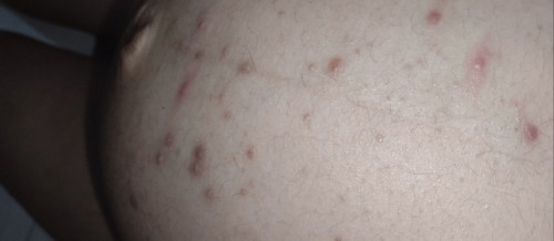 Jerawat perut, punggung,sekitar paha