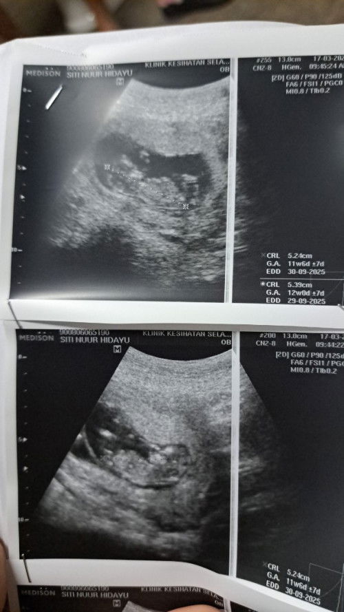 Pengalaman twin pregnancy