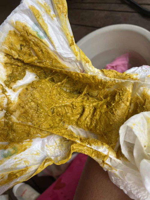 น้องอึแบบนี้ผิดปกติไหม