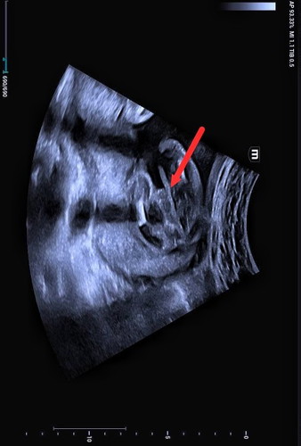 ลูกเพศอะไร??ตรงลูกศรที่ชี้👶💗