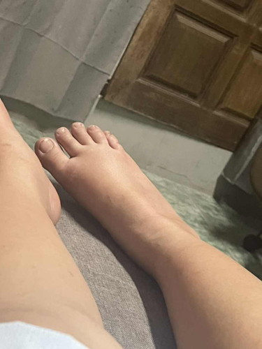 มือ เท้า บวม