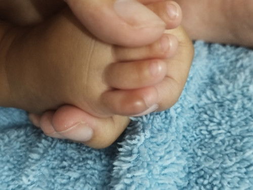 สอบถามแม่ๆค่ะ น้องเป็นตุ่มที่นิ้วเท้านิ้วก้อย
