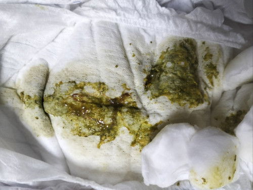 น้อง1เดือน11วันอึแบบนี้ผิดปกติไหมคะ