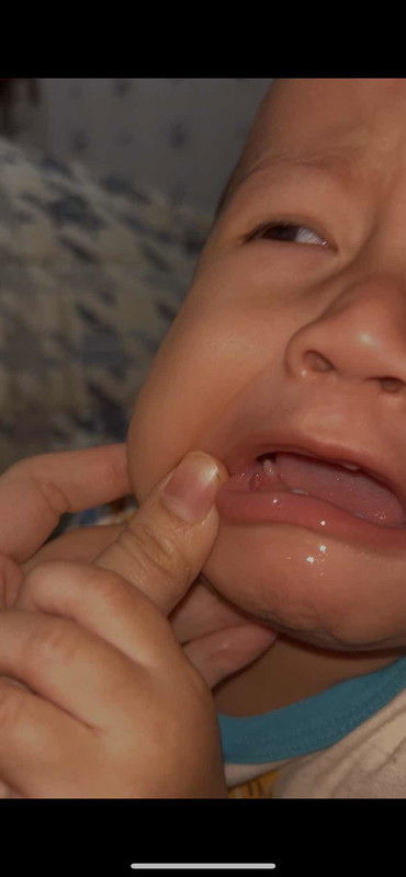 Tumbuh sesuatu di gusi anak