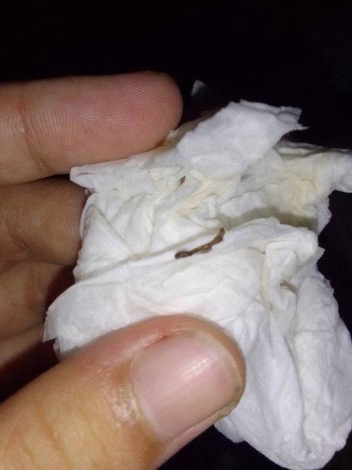 Bekas jahitan melahirkan