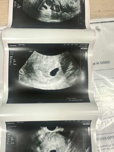 7 weeks pregnancy but only sac is visible