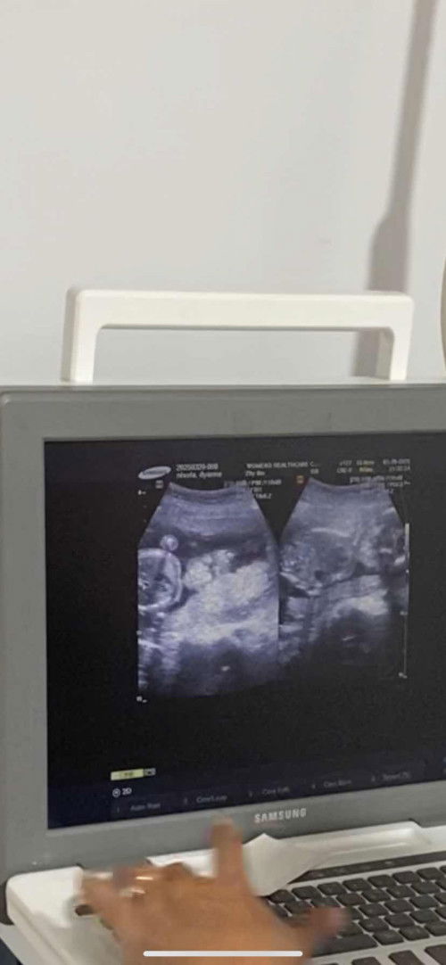 Ultrasound at 20 weeks