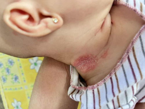 lecet di leher dan selangkangan