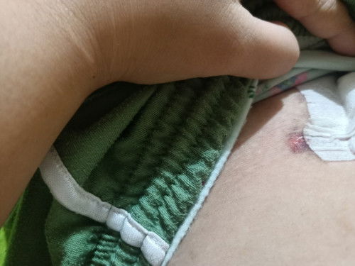 Bun mau tanya itu luka bekas op atau ap ya gk sengaja kegaruk karna gatal malah begitu 😭 jadi worry
