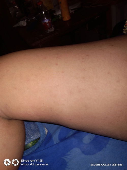 Gatal gatal disemua area.sharing dong bun ada yg pernah ngalami ga sih.aku hamil 9 week 6 day.