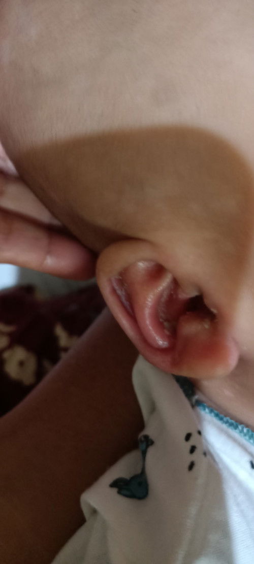 Luka dibagian lipatan