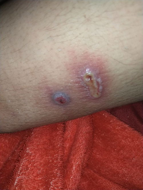 bunda mau tanya dong kan kaki aku gatal trus jadi kayak gini.. lagi hamil juga TM 3