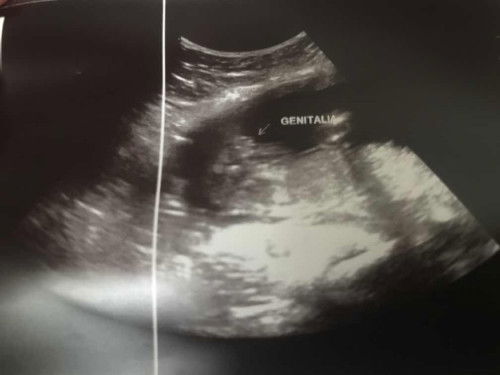Ultrasound