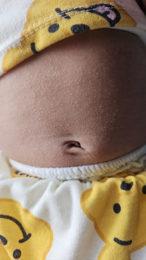 ผดผื่น ผื่นร้อน