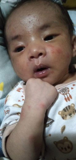 Bayi umur 3 minggu , bentol² merah seperti ini kenapa ya?Apakah alergi susu atau alergi minyak telon