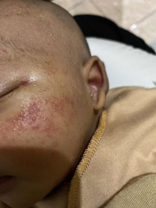 Bintik merah pada pipi newborn