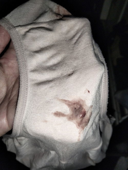 Ini flek apa keputihan campur kecoklatan