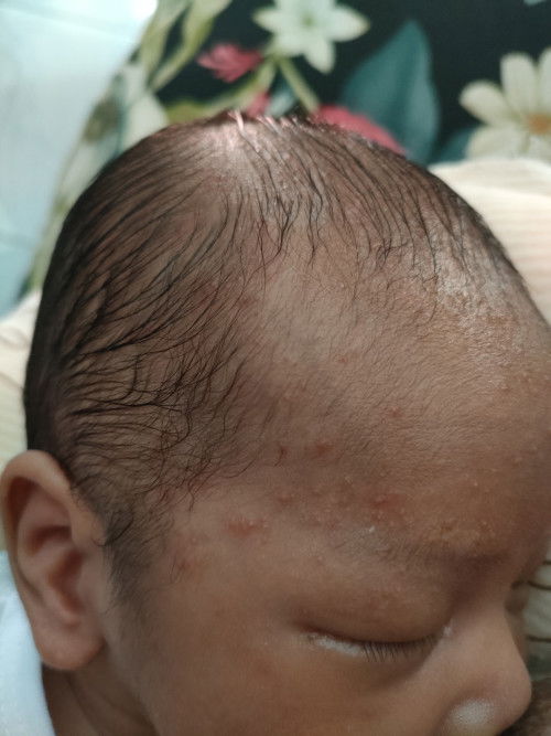 Natubong mga pula pula kay baby
