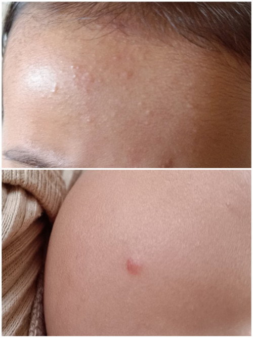Bintik kecil di wajah bayi