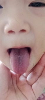 Các mon cho e hỏi lữa bé bị vậy là bị j v ạ bé e thè lưỡi mà thấy đen vs có hột liti mà hết hồn lun