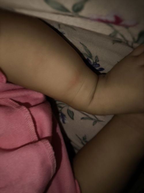 Bentol pada bayi pada 4 bulan