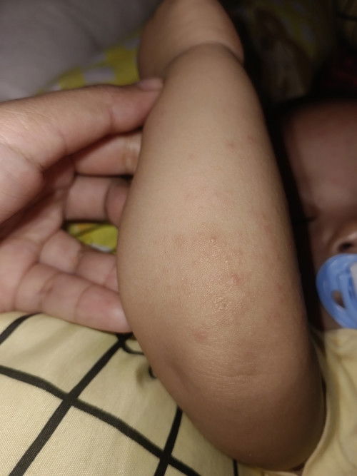 Atasi bintik merah di tangan