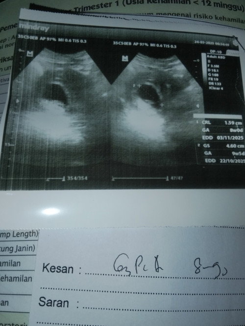 USG kehamilan 8 minggu 5 hari