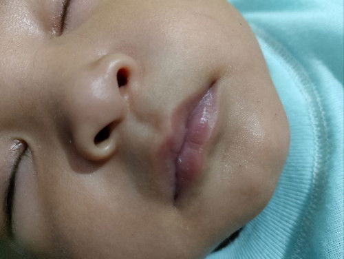Bibir bayi normal