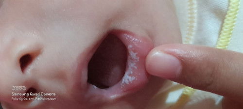 Putih2 di bibir bayi 2 bulan