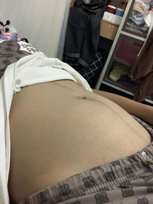 17w4d แต่ท้องขึ้นเป็นแบบนี้บางครั้ง