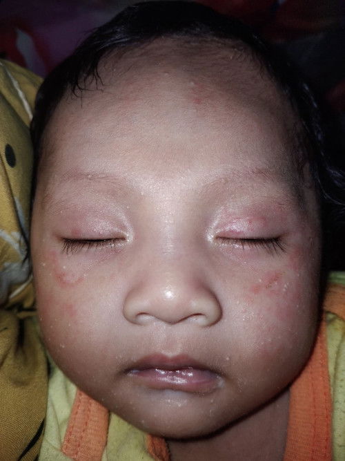 Saran bun ngilangin bintik merah di wajah bayi